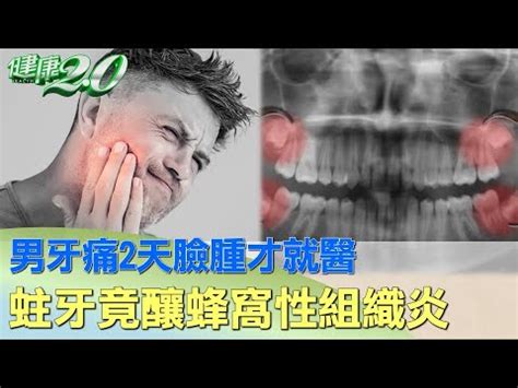 牙痛臉腫怎麼消|過年遇到牙齒不舒服、臉腫又痛...該去急診嗎？牙醫。